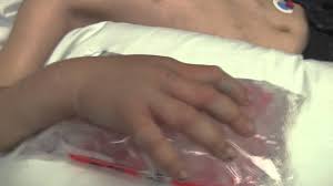 Résultat de recherche d'images pour "copperhead bites"