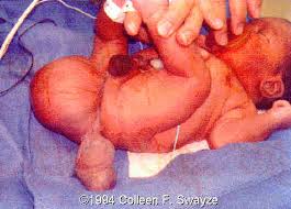 Image result for teratoma