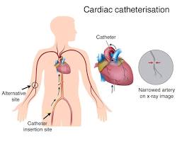 catheter being inserted into a coronary arteryの画像