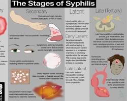 Image of Syphilis STI