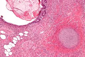 Image result for teratoma