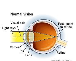 improved vision after LASIK surgery 이미지