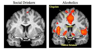 Image result for ventral striatum