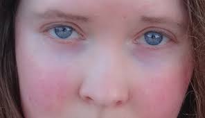 Resultado de imagen para imageness de la rosacea y su tratamiento