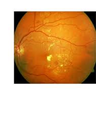 Qvision Un mayor grosor coroideo en el edema macular diabético predice mejor respuesta a antiangiogénicos. images?q=tbn:ANd9GcTvt8V361GkkIIUeUVXqndKt6SYAyMb9vjCF yheEePcaAP8DJE