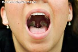 Image result for tonsilith