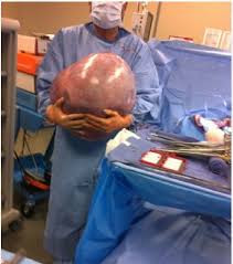 Image result for teratoma