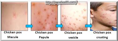 Image result for chicken pox