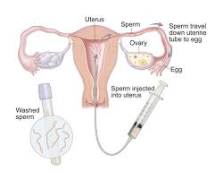 Image of intrauterine insemination diagram