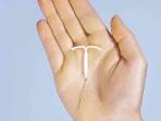 Mirena IUD Information Side Effects, Birth Control Uses Lawsuits