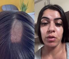 Mulher expõe falha em exame, com ‘buraco’ no couro cabeludo, e laboratório Roseanne Dore admite erro e pede desculpas