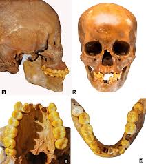 a) Lateral view of the skull. (b) Frontal view of the skull. (c) Upper... | Download Scientific Diagram