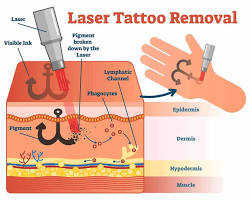 Image of laser tattoo removal process