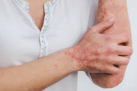 New Study Reveals Psoriasis Not Primarily Linked to Spontaneous Mutations in Skin Cells