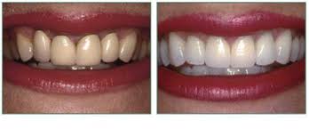 Kết quả hình ảnh cho Làm răng sứ thẩm mỹ loại nào đẹp nhất