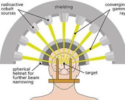 Image of Gamma Knife Radiosurgery procedure