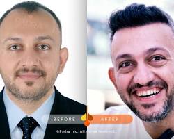 Image of نتائج زراعة الشعر قبل وبعد في عيادات الرياض للرجال والنساء hair transplant results before and after Riyadh clinics