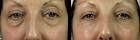 Non surgical eye bag removal london