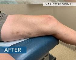 Image of Varicose veins after radiofrequency ablation