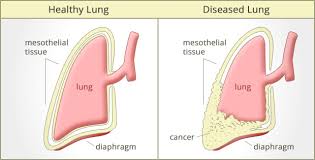 Image result for mesothelioma image