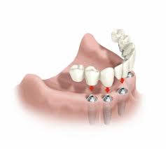 Resultado de imagem para implante dental