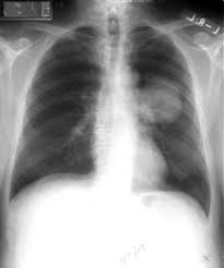 Image result for cancer radiology