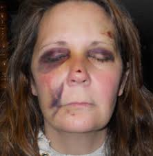 These are the pictures of Michelle Lane, a victim of Maryland post police beating by Carroll County Sheriff Deputy Zepp which left Michelle with a moderate ... - michelle-lane-beaten-2