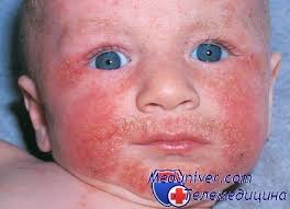 Картинки по запросу атопический дерматит у ребенка
