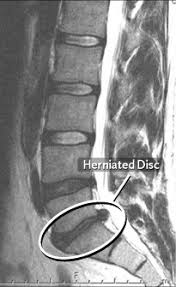 「herniated intervertebral disc  x ray」的圖片搜尋結果