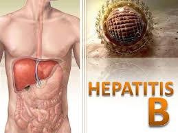 Resultado de imagen para hepatitis b sintomas
