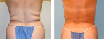 Image result for Treating Problem Areas With Smart Lipo