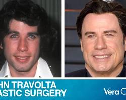 Imagen de John Travolta before and after plastic surgery