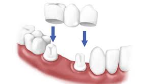 Image result for hinh cầu răng
