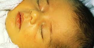 نوزاد دارای زردی