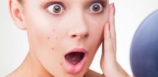 Image result for acne scar treatment