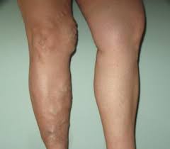 ,The, meaning, of, varicose, veins