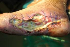 Image result for diabetic foot