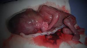Resultado de imagem para bebes abortados
