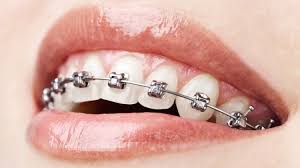 Diş Teli Uygulaması ile Mükemmel Dişlere Kavuşmak ile ilgili görsel sonucu