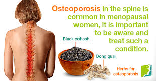 「osteoporosis」的圖片搜尋結果