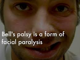 Image result for bell's palsy