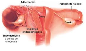 Image result for endometriosis