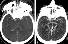 Image result for ct scan angiography