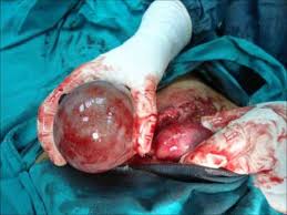 Image result for ovarian cyst stomach