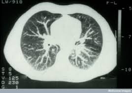 Image result for thoracic CT scan