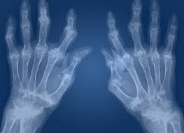 Resultado de imagen de artritis reumatoide