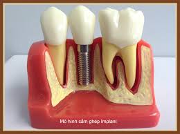Image result for hình implant răng