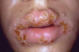 Herpes Simplex Viral Infection (Herpes Simplex Virus)