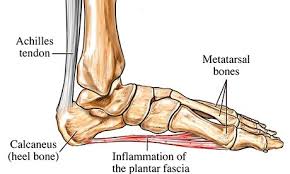 Image result for heel injury and pain