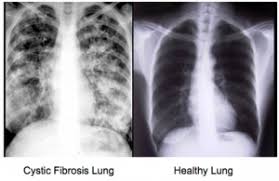 Image result for cystic fibrosis
